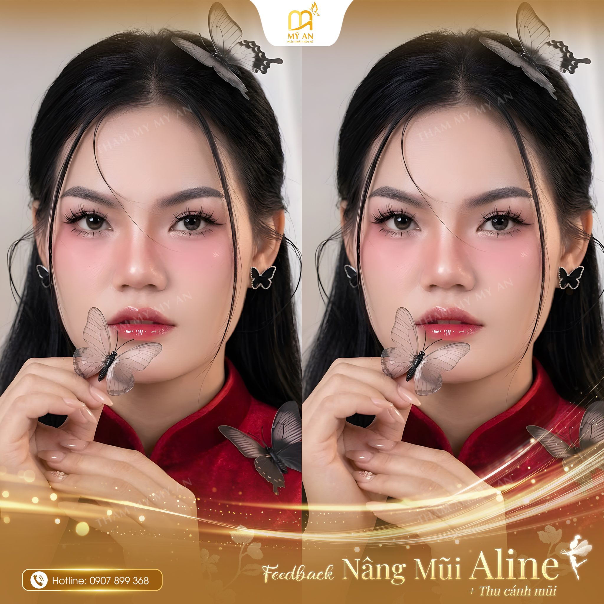 PT 11.02.24 Thị Tú 1994 Nâng Mũi Nâng Cao + Thu Cánh Mũi